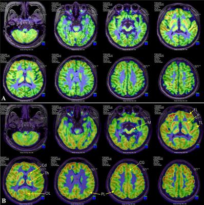 Case report: Levodopa-responsive parkinsonism with akinetic mutism after ventriculo-peritoneal shunt